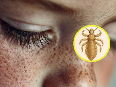 muestra de un piojo en niños